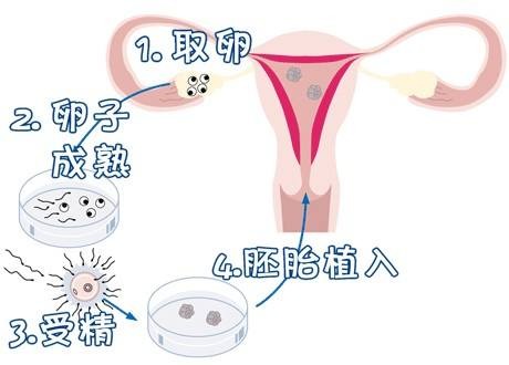 精液分析